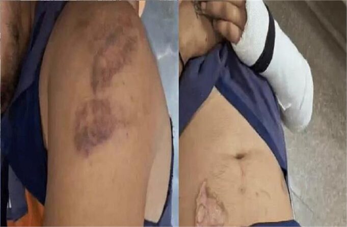 ये कैसा सिस्टम! पुलिसकर्मियों ने युवक के Private Part में डाला डंडा, ज्यादा ब्लीडिंग से हुआ बेहोश… फिर