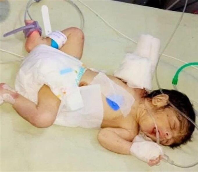 नवजात के हाथ कटने का मामला- मानव अधिकार आयोग ने सिविल सर्जन को किया तलब