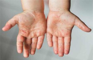 बच्चों, युवाओं और वयस्कों में बढ़े बीमारी के मामले, लक्षण पहचान कर तुरंत कराएं इलाज